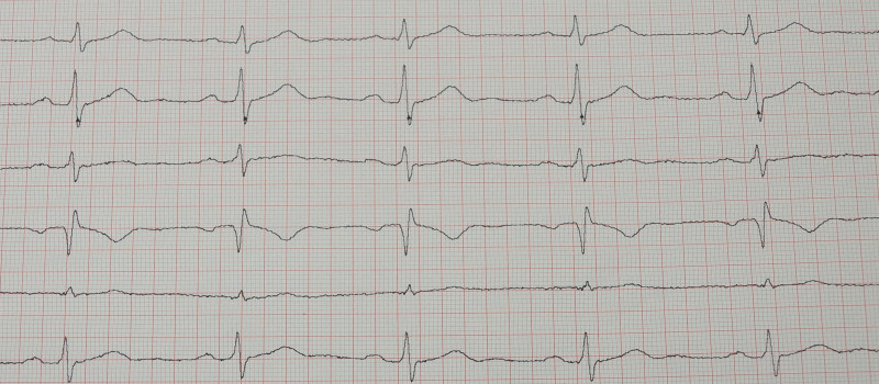 EKG Ausdruck Sinusrhythmus Herzfrequenz mit 84