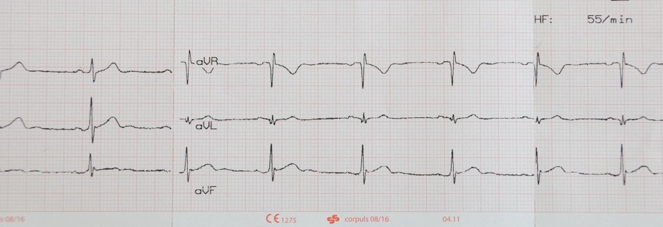 EKG Ausdruck Sinusrhythmus